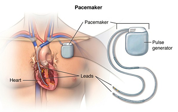 图一 : 心脏调节器包含两大部分：起搏器（pulse generator）和电极导线（lead）。（source：hopkinsmedicine.org）