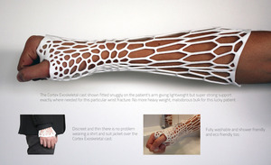 3D列印出的骨折固定石膏比傳統石膏更輕巧有型，而且容易清潔傷處。（圖：Cortex官網）