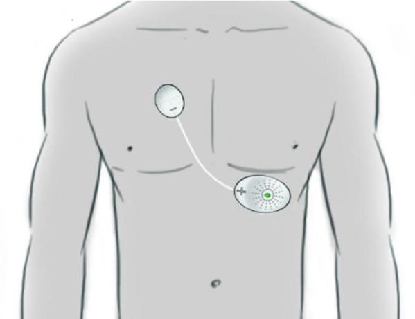 圖二 :  工研院開發具有 ECG與光電訊號量測心輸出指標的手持裝置，亦可配戴於胸口。主要訴求為心肌梗塞術後出院後短期的高風險預防。