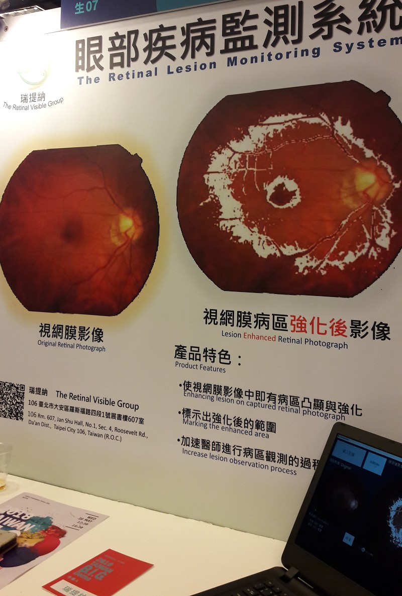 ＤＭ-35視網膜疾病偵測軟體著重術前分析，以協助眼科醫師篩檢出早期具有高風險視網膜病變的病患。(攝影╱陳復霞)