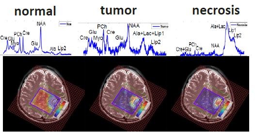 图四 : 利用数学模型，磁振造影影像可根据测得的组织频谱加上色彩。事实上，这张频谱是该组织组成的一种生化指纹，而且能更详尽地区分正常组织和肿瘤组织/坏死组织的差别。