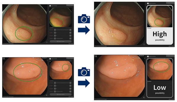 圖3 : 在檢查過程中，通過內視鏡設備拍攝的影片自動檢測疑似病變。然後醫生擷取靜止影像（左），並很快顯示分析結果（右）。（source：日本NEC）